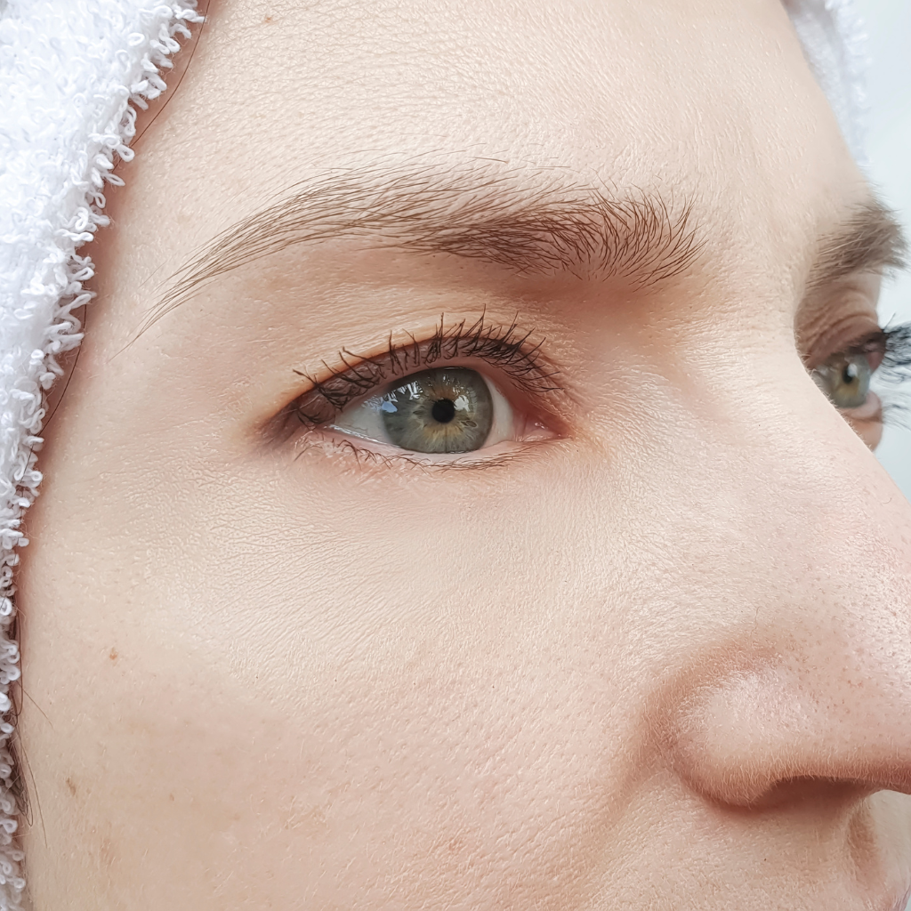 Undereye Treatment